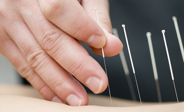 Treatment by acupuncture