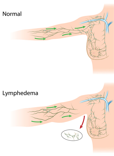 Lymphedema-cropped